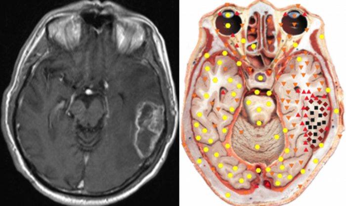 On the left side, an MRI image is displayed, and on the right is the bio-resonance scan. Notice the black squares and low energy area as displayed on the bio-resonance scan.